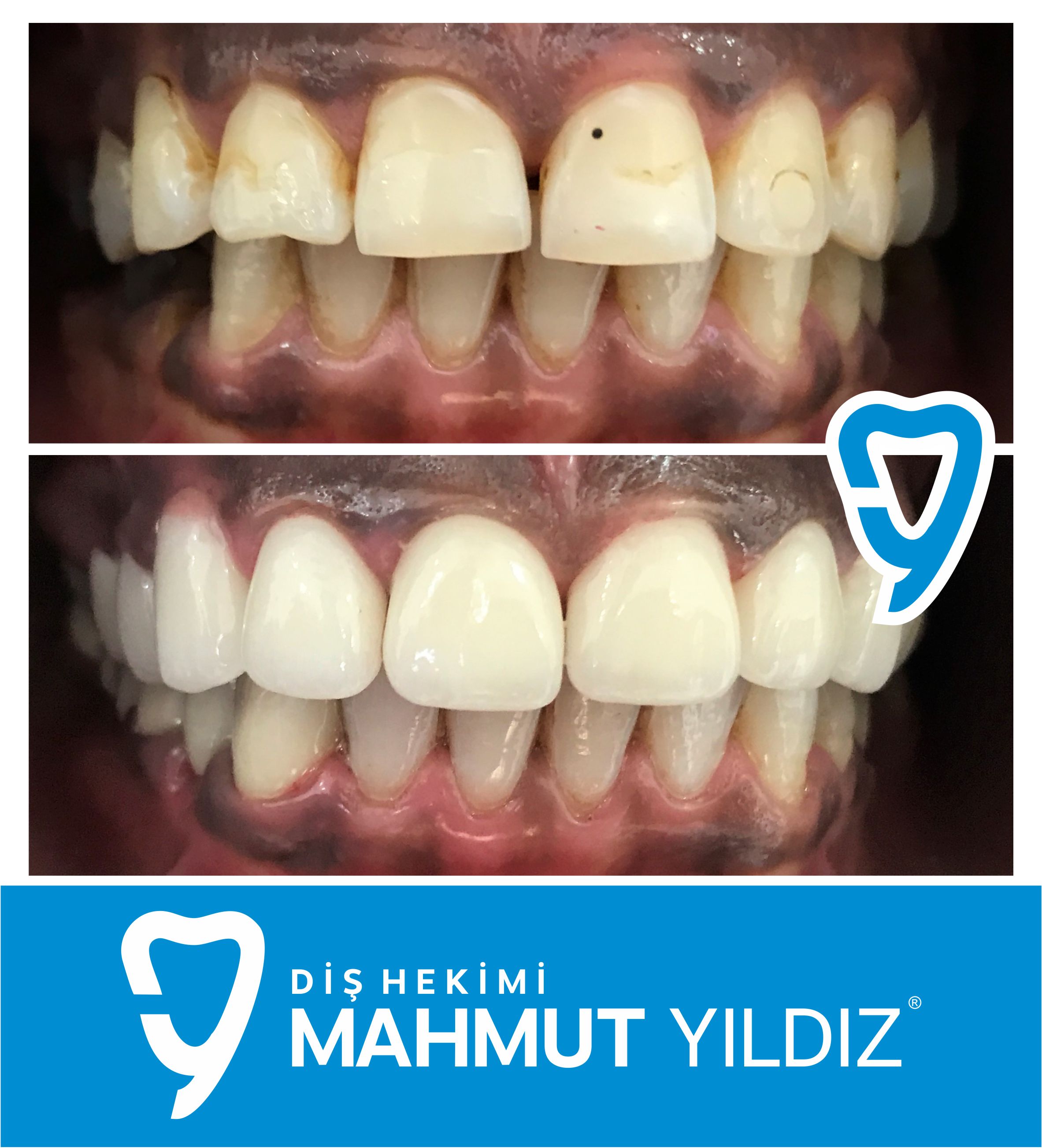 Zirkonyum ile Gülüş Tasarımı