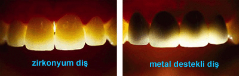 http://www.mahmutyildiz.com.tr/makale-detay/zirkonyum-nedir-zirkonyum-kaplama-nedir ZİRKONYUM NEDİR ? ZİRKONYUM KAPLAMA NEDİR ? Periyodik cetvelin IV B grubunda yer alan bir kimyasal elementtir. Külrengi beyaz renkte katı bir elementtir. 1789 yılında Martin Heinrich Klaproth tarafından bulunmuştur. Diş Hekimliğinde ise hem çok sert ve sağlam bir yapısı olmasının yanı sıra ışık geçirgenliğinden dolayı çok estetik bir yapıya sahip olmasından dolayı tercih edilmektedir. Zirkonyum Kaplama Nedir ? Estetik açıdan yetersiz kalan ve ya daha sağlam bir diş yapısına ulaşabilmek için dişlerin üzerine zirkonyumdan yapılan kaplamalara zirkonyum kaplama denilmektedir. Porselen ile Zirkonyum arasından çok fark var mıdır ? Porselende diş kaplamalarda sıkça kullandığımız bir materyaldir ancak eskiden zirkonyum kullanılmadığı için porselene yönelim artmıştır ancak günümüzde zirkonyumun he daha sağlıklı hem daha dayanıklı hemde daha estetik olduğu kesinleşmiştir. Randevu için: 0342 341 71 10 Web:www.mahmutyildiz.com.tr Adres: Atatürk mah. Cemil Sait Barlas Cad. No12/A İbrahimli/Şehitkamil/Gaziantep Diş Hekimi Mahmut Yıldız